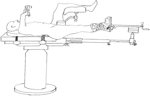 Figure 1 Positioning scheme of the legs in the hemilithotomy position. (IF Brouze).