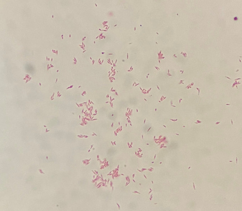 Figure 5 Acid-fast staining of the bacterial suspension demonstrated acid-fast bacilli.