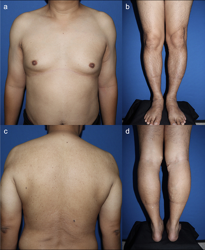 Figure 2 Skin resolution occurred after receiving prednisolone 30 mg/day with a gradual taper off over 8 weeks of treatment and prednisolone was discontinued after 12 weeks of treatment. The skin resolution of the trunk (a and c) and extremities (b and d) was demonstrated.