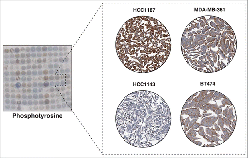 Figure 6. Immunocytochemical staining of tyrosine phosphorylated proteins. The left panel shows a CMA slide stained with an anti-phosphotyrosine monoclonal antibody. The panel on the right shows a magnified view of 4 representative cell lines showing different levels of tyrosine phosphorylation. SUM159, BT474 and HCC1500 showed relative high tyrosine phosphorylation levels, while SUM149 demonstrated low tyrosine phosphorylation.