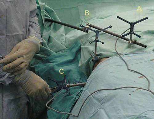 Figure 3. Table-mounted (A) and iliac-crest–mounted (B) dynamic reference frame attachments. The drill guide (C) is also visible.