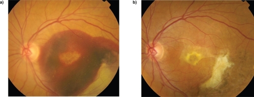 Figure 2 Female aged 76 years (patient no. 8). Baseline fundus photograph (a) and 12 months after the surgery (b). Visual acuity improved from 20/800 to 20/200. No further treatment was needed during the 20-month follow-up.