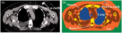 Figure 2. Patient model generation. (A) CT slice in which the port-a-cath is indicated by the arrow, (B) segmented CT slice in which the port-a-cath (grey), lung (blue), bone (yellow), muscle (brown) and fatty tissue (orange) are segmented. For the control model, the port-a-cath is segmented as fatty tissue.