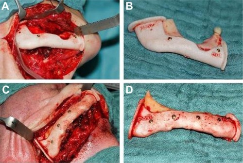 Figure 2 Mandibular resection guides.