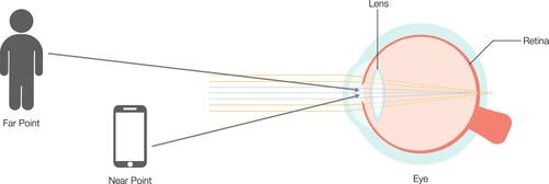 Figure 4 Varying the refractive power across a range of distances (pseudoaccomodation) achieves simultaneous focus from far (person) to near (smartphone). In this illustration, an iris pinhole optic provides pseudoaccomodative ability.