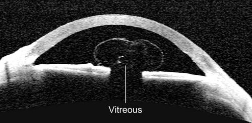 Figure 3 Anterior segment optical coherence tomography showed mushroom-shaped vitreous after laser peripheral iridotomy.