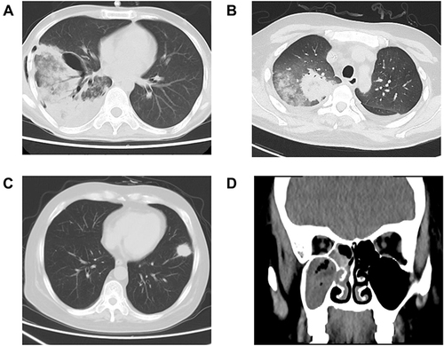 Figure 2 Imaging results of patients 1 to 4. The imaging results of patients 1–4 indicate that there may be fungal infection. (A) Chest CT indicates right pneumonia and pneumothorax. (B) Chest CT indicates bilateral pulmonary inflammation and bilateral pleural effusion. (C) Chest CT shows nodules in the anterior basal segment of the lower lobe of the left lung. (D) Imaging results showed inflammation of the right maxillary sinus and sphenoid sinus.