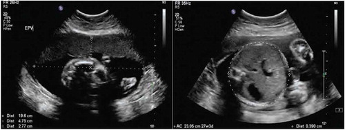 Figure 2. Example of an ultrasound report for establishing estimated measurements of Estimated Foetal Weight (EFW), Estimated Placental Volume (EPV), and foetal body composition of an HMZ participant.