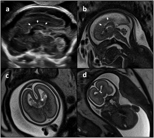 Figure 1. Fetal neuroimaging findings. Ultrasound (a) and magnetic resonance imaging (b) of the sagittal view showing the hypoplasia of the corpus callosum (white arrows). Magnetic resonance imaging of the transverse (c) and coronal (d) view showing partial separation of the frontal lobe (white asterisk), incomplete development of the corpus callosum and the presence of the sagittal scissure (white arrowhead), suggestive of lobar holoprosencephaly.