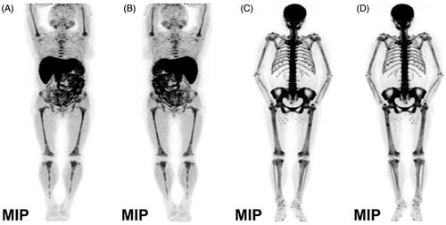 Figure 2. The maximum intensity projection of whole body bone on 18F-fluorocholine and 18F-NaF PET/CT imaging.