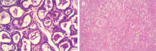 Figure S6 Histopathology images (stained with H&E [×400]) for Case 3.Notes: (A) Well-differentiated tubular adenocarcinoma before treatment. Carcinoma arranged in tubular pattern. Mass characterized by an intra-acinar deeply basophilic secretion and corpora amylecea. Connective tissue stroma infiltrated with mononuclear cells (tumor Grade III). (B) 2 weeks after the third treatment, there was absence of epithelial lining of acini and absence of acini and basement membrane. Also, loss of acinar pattern proliferation of fibrous connective stroma was seen (tumor Grade 0). Magnification of histopathology images stained with H&E: (A) ×200; (B) ×100.Abbreviation: H&E, hematoxylin and eosin.