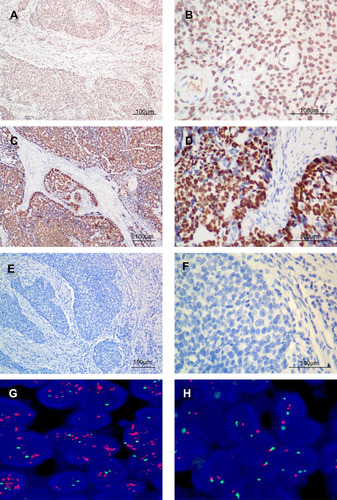 Figure 1 Immunohistochemical staining for MDM2 and p53 in human oesophageal carcinoma. The data show expression levels of MDM2 (A×100, B×400) and p53 (C×100, D×400) compared with the negative control (E×100, F×400) in tumour tissues from patients with OSCC. Amplification of the MDM2 gene (G×1000) compared with the negative control (H×1000) according to FISH in tumour tissues from patients with OSCC.