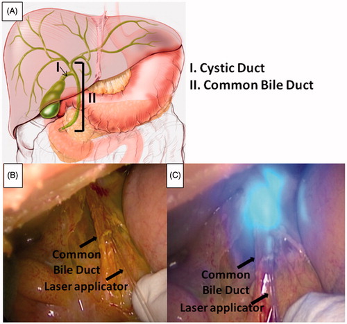 Figure 2. Schematic of biliary tree anatomy (A). Laser applicator insertion into the common bile duct through a 1 cm longitudinal incision (B) and LA (C). Pictures were taken using the snapshot function of the laparoscopic camera.