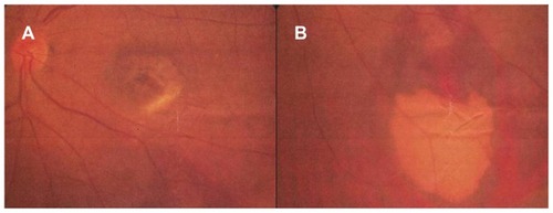 Figure 2 Fundus findings of the left eye after the first intravitreal ranibizumab injection.
