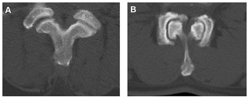 Figure 4 Examples of factors that may influence the facet joint area. (A) Vertebral displacement can lead to changes in the facet joint area. (B) Despite severe hyperplasia and sagittalization, the facet joint area increased because of the lengthening of the joint surface.