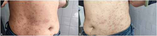 Figure 1 (A and B) Patient at baseline.