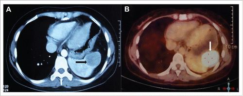 Figure 2. Abdominal computed tomography (CT) scan revealed a moderate contrast enhanced lesion that measured 4.5 cm × 3.5 cm in the spleen (A), which was confirmed by fluorodeoxyglucose positron emission tomography (PET/CT), with the SUVmax of 30.67 (B).