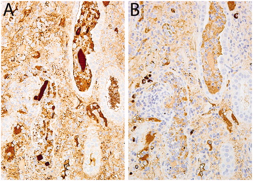 Figure 2. A&B: The crystals stained intensely (3+) for lambda light chains (A) but not (0) for kappa light chains (B), Immunoperoxidase stains, 40×.