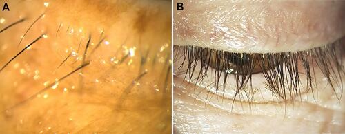 Figure 1 Slit-lamp photograph of cylindrical dandruff attached around the base of eyelashes. A: Magnified view of single cylindrical dandruff at the center of the figure. B: An overall view of a patient with multiple cylindrical dandruff adhered to the base of eyelashes.