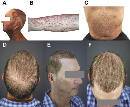 Figure 12 Case 1: Using the all-purpose FUE device, the Average Head Skin Thickness/Firmness, Body Hair Areas, and Beard Area hair presets were used for universal FUE. Post-operative photos of the head and beard: (A) forearm, (B) chest, and abdomen (C). Using hairs harvested from the head, beard, chest, stomach area, forearms, and pubic areas, global restoration was achieved. Results after one year: (D) Bird’s eye-view from the posterior; (E) right oblique view; and (F) bird’s eye-view from anterior.