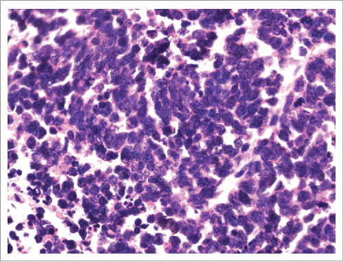 Figure 7. A repeat biopsy of pleural nodule was identified small cell lung cancer