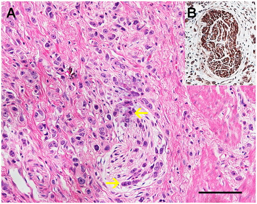 Figure 2. (A) The representative microphotographs of neural invasion (NI) in gastric cancer assessed by HE staining (magnification: ×200, scale bar: 10 μm). NI was assessed as positive if the cancer cells presented along the sides of nerves and/or inside the epineurial, perineurial and endoneurial spaces of the neuronal sheath. (B) The nerve fiber was confirmed with the immunohistochemistry of a specific neuronal marker (PGP9.5).