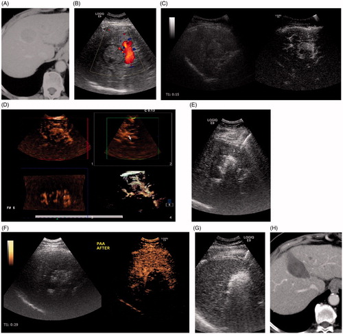 Figure 3. An 80-year-old woman with hepatocellular carcinoma at S4 was treated using PAA + RFA. (A) CT showed the tumor located at S4 with a 3.7-cm diameter. (B) Color Doppler ultrasound showed the feeding artery of the tumor. (C) CEUS showed that the tumor was hyper-enhanced in the arterial phase. (D) 3D-CEUS showed the feeding artery of the tumor (arrow). (E) The feeding artery and surrounding liver parenchyma were ablated by two electrode needles inserted parallel to each side of the artery. (F) Immediate CEUS showed that the tumor was under ischemic conditions. (G) Then, the whole tumor was coagulated under ultrasound guidance. (H) Enhanced CT 4 months after ablation showed that the tumor had completed necrosis.