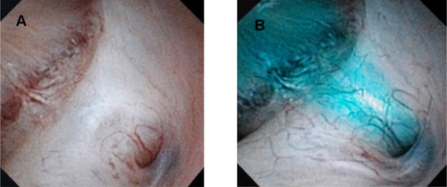 Figure 1 A refluxing technique with methylene blue was used to identify the diverticular opening. (A) Suspected opening. (B) Refluxing of methylene blue through the opening.