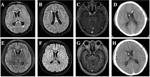 Figure 2 Brain MRI and CT scan at admission (A-D) and 2 months after antituberculosis therapy (E-H).