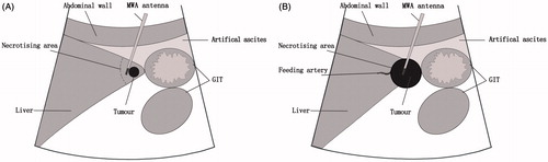 Figure 1. Diagram illustrating the technical essentials for thermal ablation of a tumour adjacent to the liver marginal angle (LMA). (A) For small tumours the microwave ablation (MWA) antennae should be placed on the lateral margin of the target lesion opposite the angle side to achieve a segmental block of the entire acute angle. (B) Larger tumours tend to be exophytic towards the extrahepatic organs. Initially, the feeding artery should be blocked under the guidance of contrast imaging to improve the thermal efficiency. Next, the MWA needle should be placed intralesionally to achieve a conformal ablation. GIT, gastrointestinal tract.