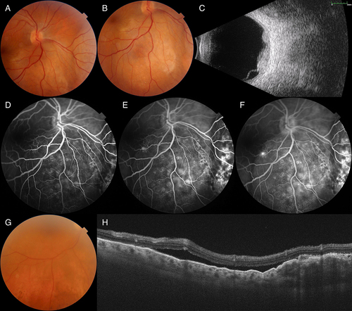 Figure 3 Multimodal imaging in choroidal metastases. (A and B) Color fundus photographs show multiple metastatic breast cancer lesions inferior and nasal to the optic disc in the right eye. (C) B-mode ultrasonogram demonstrates multiple acoustically solid lesions with exudative retinal detachment. (D–F) Fluorescein angiogram shows increasing globular hyperfluorescence throughout the angiogram at 30 seconds, 3 minutes, and 5 minutes (from left to right) in the tumor, respectively. (G) Color fundus photograph of choroidal metastasis in a patient with breast cancer shows metastatic lesion inferior to the inferior vascular arcade. (H) Swept source optical coherence tomography reveals lumpy bumpy appearance of the tumor, subretinal highly reflective dots, and associated subretinal fluid.