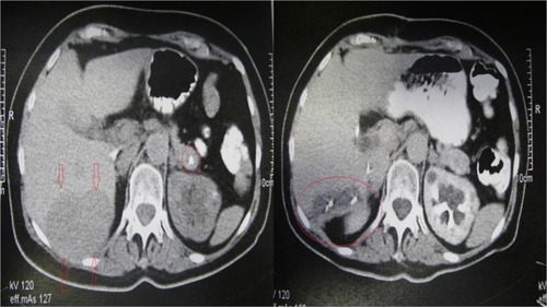 Figure 1 Left: Preoperative abdominal CT. Solid hepatic lesion at segments VI and VII (arrows) and calcified lesion at the tail of the pancreas (circle). Right: Postoperative abdominal CT. Subcapsular hepatic fluid collection without recurrence of the HCC (circle).