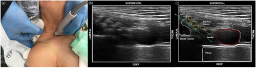 Figure 8. (a) In-plane needle insertion at the lateral border of the probe during an ultrasound-guided supraclavicular BP block. This photo was included with the consent of Dr Möhr. (b) Ultrasound scan as it appears on the ultrasound screen during an ultrasound guided supraclavicular BP block. (c) In-plane needle insertion with the entire needle course visible on ultrasound screen during an ultrasound guided supraclavicular BP block.