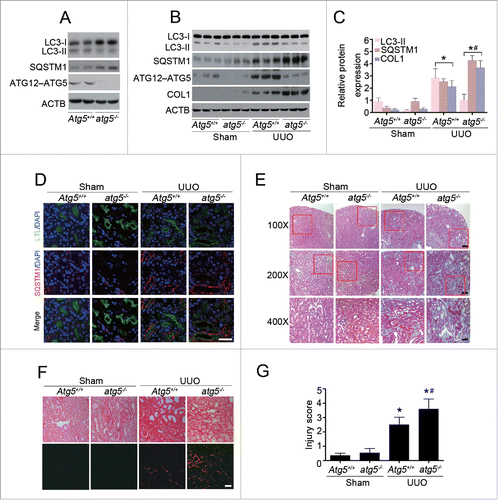 Figure 3. Proximal tubular epithelial cell-specific Atg5 deletion exacerbates UUO-induced renal fibrosis. (A) Immunoblot analyses of ATG12–ATG5 conjugation, LC3 and SQSTM1/p62 in the kidneys of Atg5+/+ and atg5−/− mice. (B) Immunoblot analyses of proteins in the kidneys from sham-operated and at d 7 after UUO in Atg5+/+ and atg5−/− mice. (C) Relative expression levels of the indicated proteins normalized to ACTB in Atg5+/+ and atg5−/− mice. Data are means ± SEM (n = 6); *, P < 0.001 vs. sham; #, P < 0.05 vs. Atg5+/+ mice with UUO. (D) Coimmunostaining of LTL (green) and SQSTM1/p62 (red) on kidney sections. Scale bar: 20 μm. (E) Representative micrographs of kidney histology with Masson's trichrome staining from Atg5+/+ and atg5−/− mice. Scale bar: 80 (upper panels), 40 (middle panels), and 20 (lower panels) μm. (F) Representative images of Sirius red-stained sections of sham-operated and 7 d-obstructed Atg5+/+ and atg5−/− mice. Scale bar: 20 μm. (G) Semiquantitative analysis of tubular damage in the obstructed kidneys. Data are means ± SEM (n = 6); *, P < 0.05 vs. sham; #, P < 0.05 vs. Atg5+/+ mice with UUO.