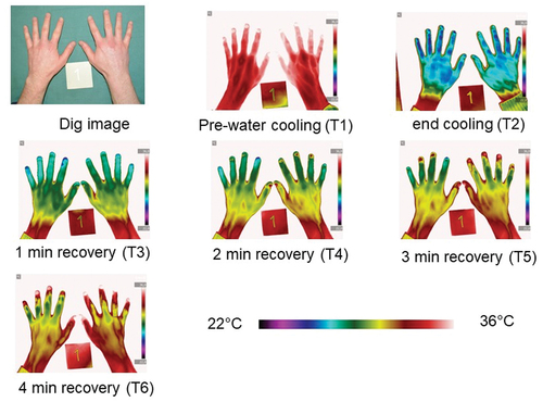 Figure 4. Thermographic images from patient 1 exemplify the rewarming of the dorsal side of the hands at 6 months follow-up encompassed a pre-cooling phase (T1), a cooling phase with hands immersed in water for one minute (T2), and a four-minute recovery phase (T3, T4, T5 and T6) demonstrated by Dynamic Infrared Thermography.