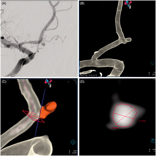 Figure 2. (A) A 35-year-old woman presented with a subarachnoid hemorrhage from rupture of a 2.1 × 2.5 × 2.8 mm aneurysm located at the junction of the A1 and A2 divisions of the right anterior cerebral artery. Digital subtraction angiography (oblique view) was used to visualize the small, ovoid-shaped aneurysm. Three-dimensional computer reformatted images (B), along with Aneurysm Analysis Software, Siemens Syngo 4D workstation (Siemens Healthineers, Erlangen, Germany) (C, D), were used to confirm the dimensions of the ruptured aneurysm.