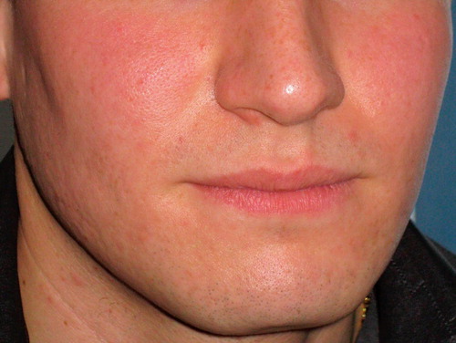 Figure 2. Complete clearance of the warts and acneiform papules after two sessions of MAL-PDT.