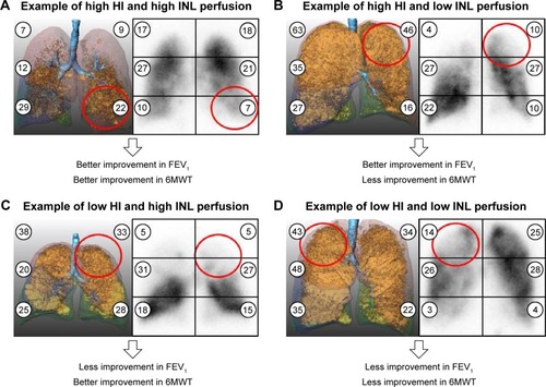 Figure 1 Quantification of baseline CT and perfusion scintigrams prior to ELVR with valves.