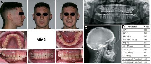 Figure 2 Pre-treatment records of patient MM2: (A) extraoral and intraoral photos; (B) panoramic radiograph; (C) cephalometric radiograph; (D) cephalometric measurements.