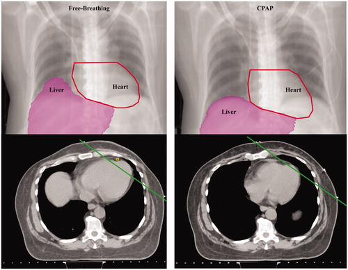 Figure 1. Physical changes in the thorax with continuous positive airway pressure (CPAP) compared to free-breathing in patients with different cardiac–thoracic anatomy. Digitally reconstructed radiographs (top) and axial images (bottom) from computed tomography simulation scans representative thoracic changes with free-breathing and after 30 min of CPAP breathing under the individual maximum tolerable air pressure (between 6 and 15 cmH2O with 0.21 of fraction of inspired oxygen with the use of a mask interface) in patients with different cardiac–thoracic anatomy (CTA). Unfavorable CTA was defined per Taylor et al.,5 the maximum distance >1 cm between the heart contour and the posterior edge of the tangent field as measured on computed tomography simulation with FB. Chest wall deformity with pectus excavatum was considered as challenging CTA. If the patient did not meet the two descriptions stated above, the patient was categorized as favorable CTA. Panel A, B, and C shows patient with favorable-, unfavorable-, and challenging CTA, respectively (Supplementary Figures S1 A and B with favorable- and challenging CTA, respectively).