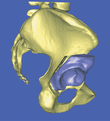 Figure 8. Presurgical planning and performance of a Bernese periacetabular osteotomy on a 3D model. This technique permits preoperative optimization of anterior and lateral acetabular roof coverage, and medialization with detection of bone interference. [Color version available online.]