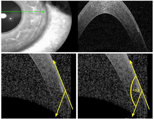 Figure 7 FemtoLASIK flap with a very large inverted angle (155°). Abbreviation: femtoLASIK, femtosecond laser-assisted in situ keratomileusis.