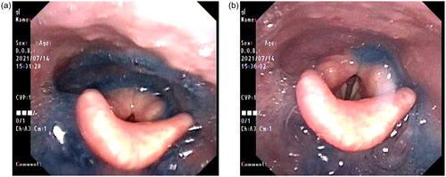 Figure 1. Endoscopic findings of pre- (a) and post- (b) cervical cooling. Pooling of saliva and pharyngeal residue of colored water were dramatically decreased.