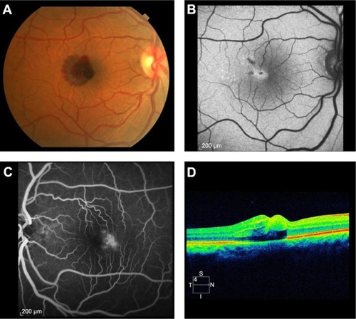 Figure 3 Fundus photographs and arteriovenous phase of fluorescein angiogram in case 3.