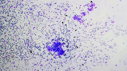 Figure 2 Under10X magnification, shows a hemorrhagic background containing single cells and cohesive clusters of slender spindle cells with a tapper-ended nucleus, along with small mature lymphocytes and plasma cells in the background.