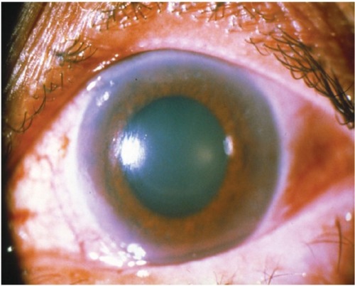 Figure 1 Acute angle-closure glaucoma.