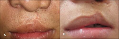 Figure 5 These images (A and B) illustrate too short lip skin deformities.