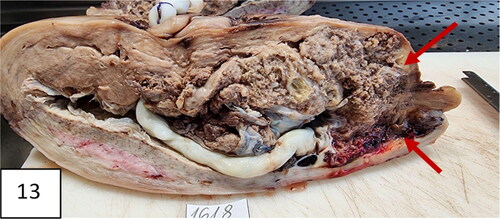 Figure 13. A uterus with invasion of placenta to the uterus cicatrix. Thinning of the cicatrix with loss of myometrium in the zone (arrows). Placenta previa, more anterior and less posterior; vasa previa.