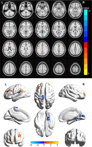 Figure 1 Spontaneous brain activity in the monocular blindness and healthy control groups.Notes: Significant brain activity differences were observed in the left cerebellum anterior lobe, right parahippocampal gyrus, right cuneus, left precentral gyrus, left paracentral lobule, right middle frontal gyrus, left middle frontal gyrus and left supramarginal gyrus. The red or yellow denotes higher ALFF values, and the blue areas indicate lower ALFF values, respectively (P<0.01 for multiple comparisons using Gaussian random field theory [z>2.3, P<0.01, cluster >40 voxels, AlphaSim corrected]).Abbreviations: ALFF, amplitude of low-frequency fluctuation; L, left; R, right.