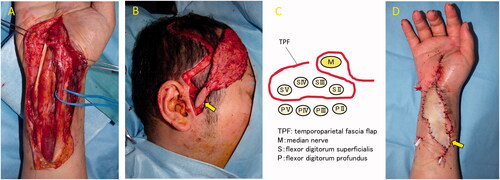 Figure 3. Intraoperative photograph. The wound was filled with an inflamed synovial sheath (A). A temporoparietal fascia flap was harvested from the right temporal region. A skin paddle (arrow) was made from the anterior part of the right ear (B). The median nerve was wrapped in the flap and then placed between FDS and FDP (C). A full-thickness skin graft was harvested and grafted onto the flap. Arrow indicate anastomosis sight (D).